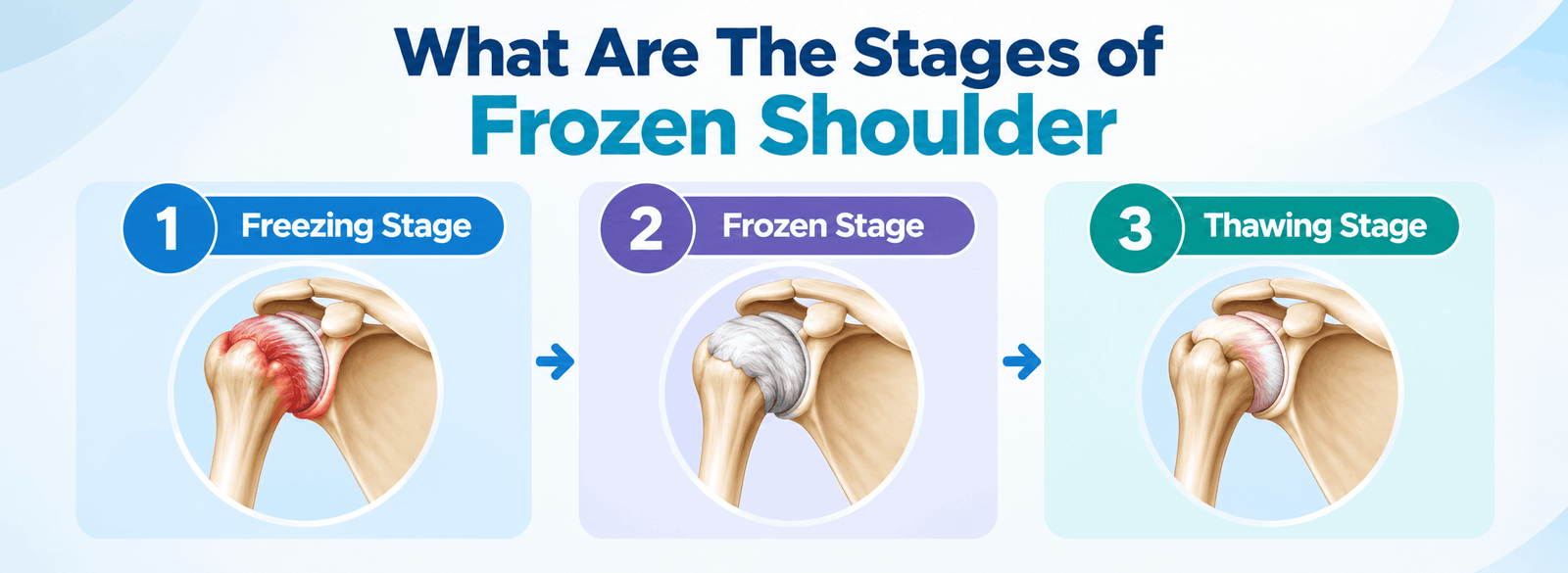 Frozen shoulder